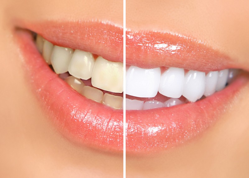 teeth whitening services Deerfield, NH